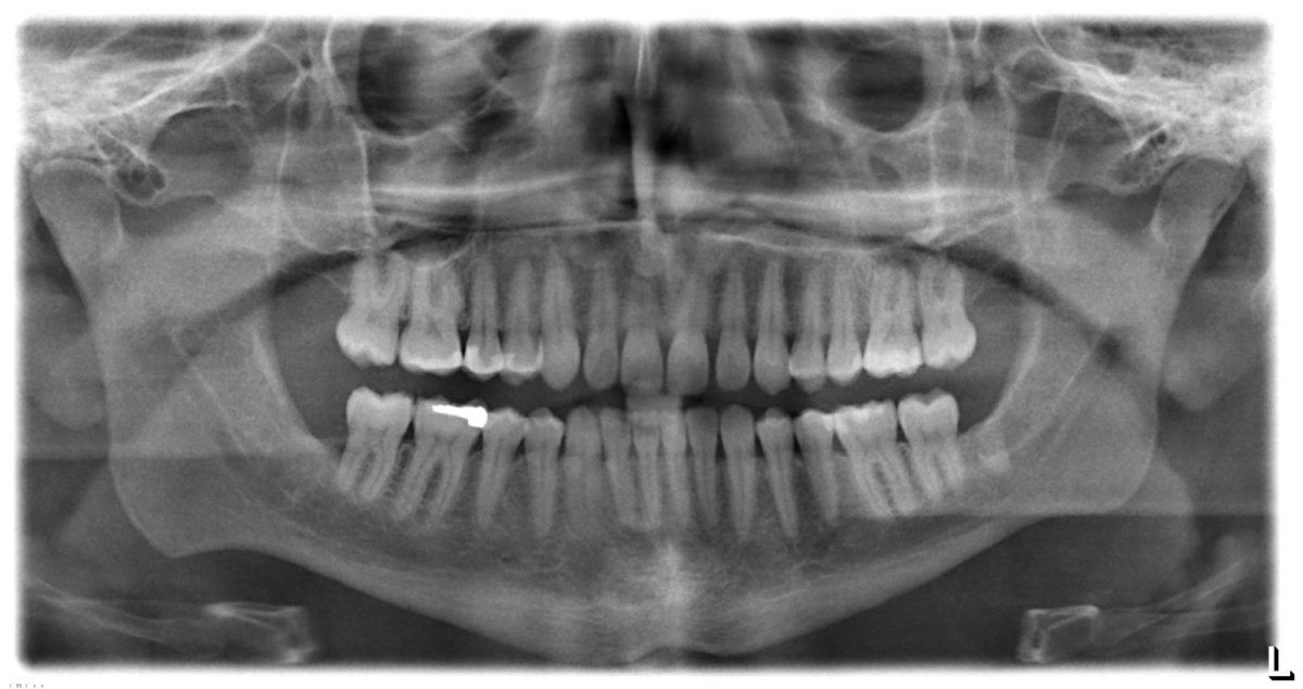 Dental x-rays in age assessment: art not science